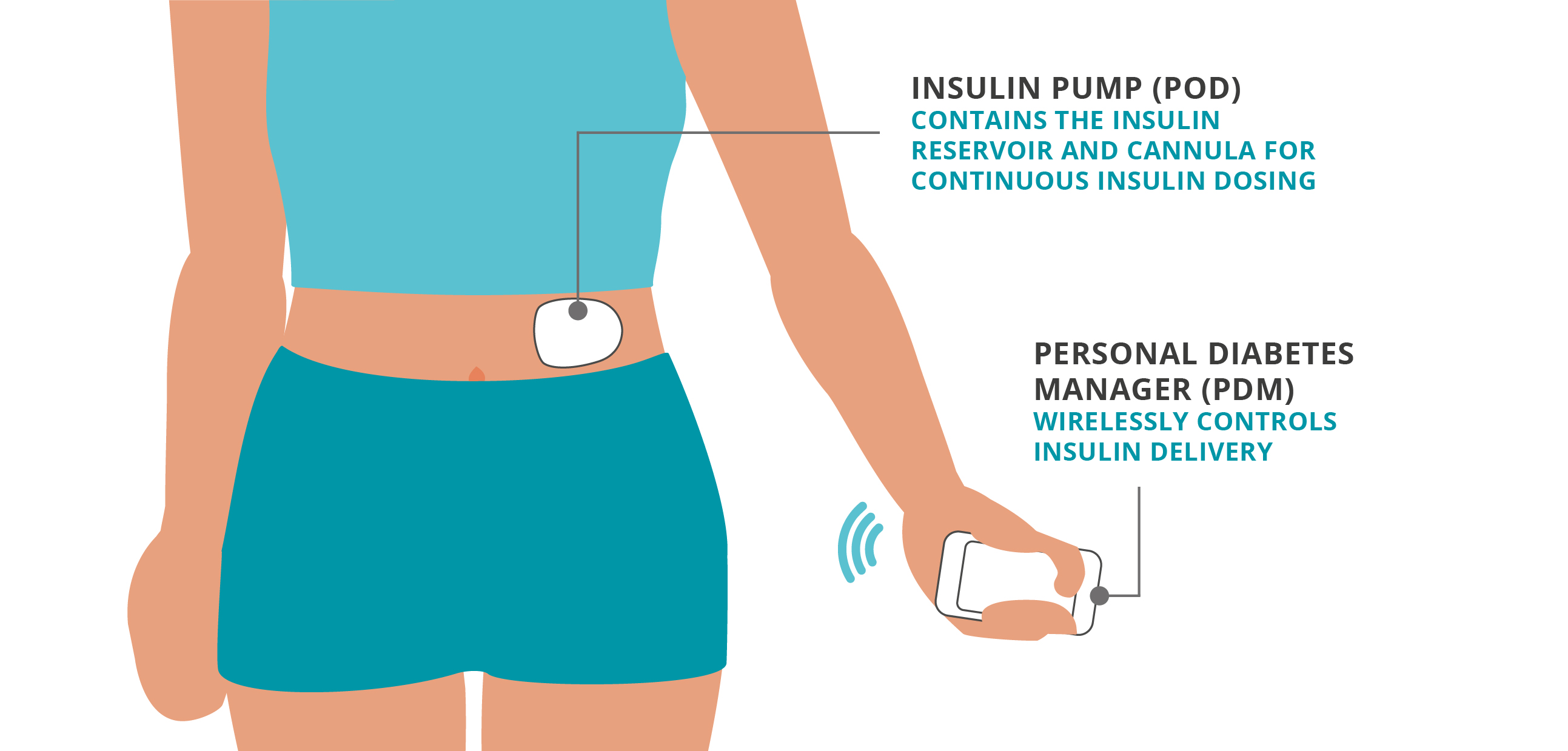 Insulin Pumps: Types & How They Work | Omnipod UK!